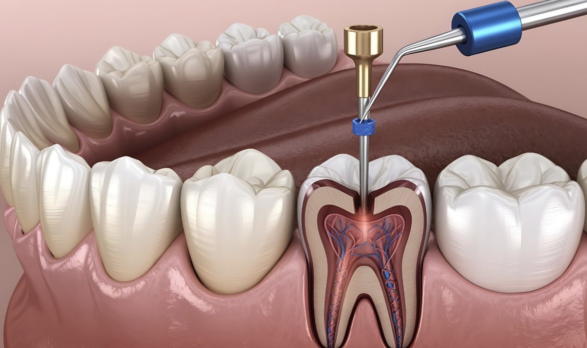 Endodoncia