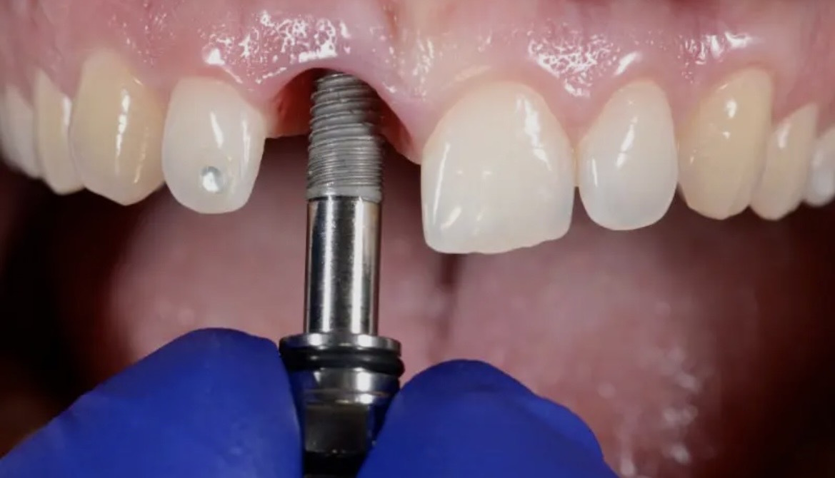 Implantes